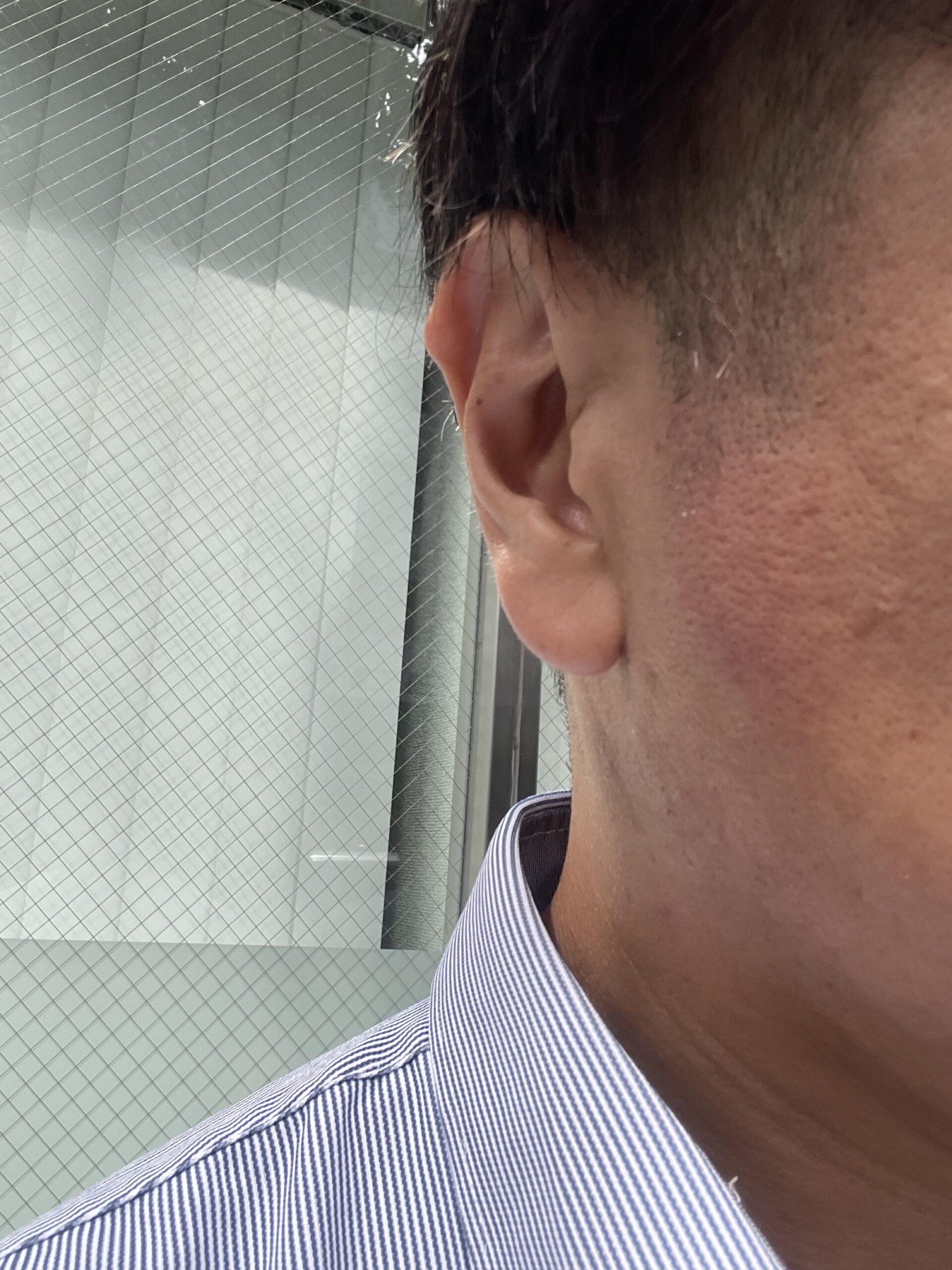 ニードル脱毛施術後・もみあげ（全処理完了）